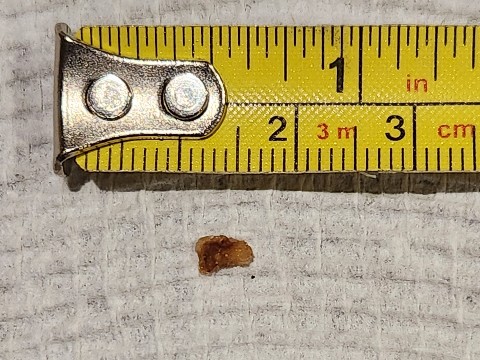 Kidney stone, August 2024